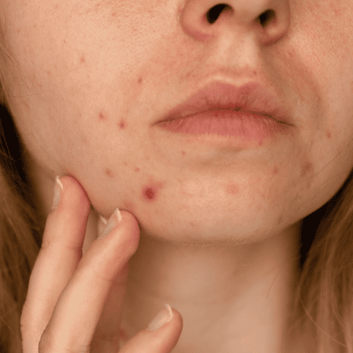 Texture & Scarring