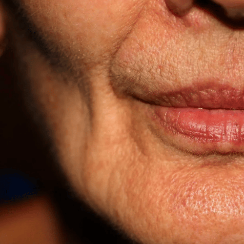Skin Laxity & Firmness