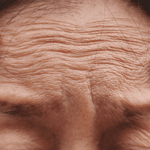 Fine Lines & Wrinkles