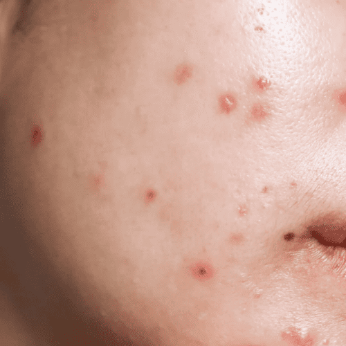 Breakouts & Adult Acne